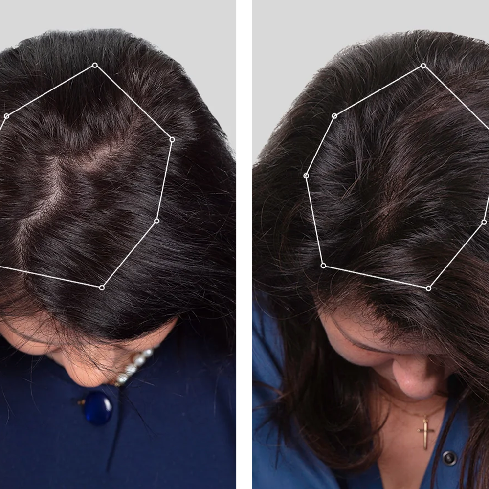 Nordic hair growth kasket