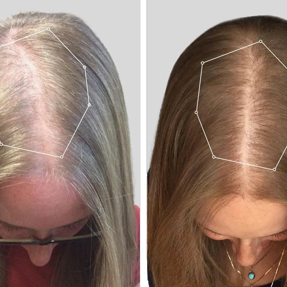 Nordic hair growth kasket